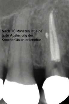 Nach zehn Monaten ist die Knochenentzündung völlig ausgeheilt, da der Zahn von den Bakterien befreit ist.