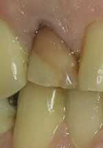 Ausgangspunkt 2006: Der stark verfärbte Zahn ist nach 30 Jahren plötzlich schmerzempfindlich.