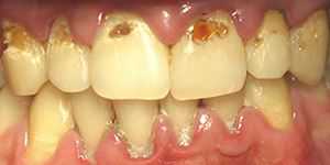 Fortgeschrittene Zahnhalskaries. Ursache sind meist schlechte Mundhygiene in Kombination mit häufigem Zuckergenuss in Nahrung und Getränken.