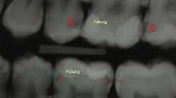 Röntgenbilder sind ein wichtiges Hilfsmittel bei der Karies-Diagnostik. Die mit C's markierten dunklen Stellen zeigen verschieden weit fortgeschrittene kariöse Läsionen.