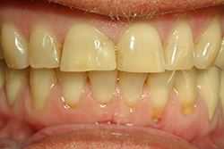 Die Zähne wurden in einer Fremdpraxis mäßig abgeschliffen.